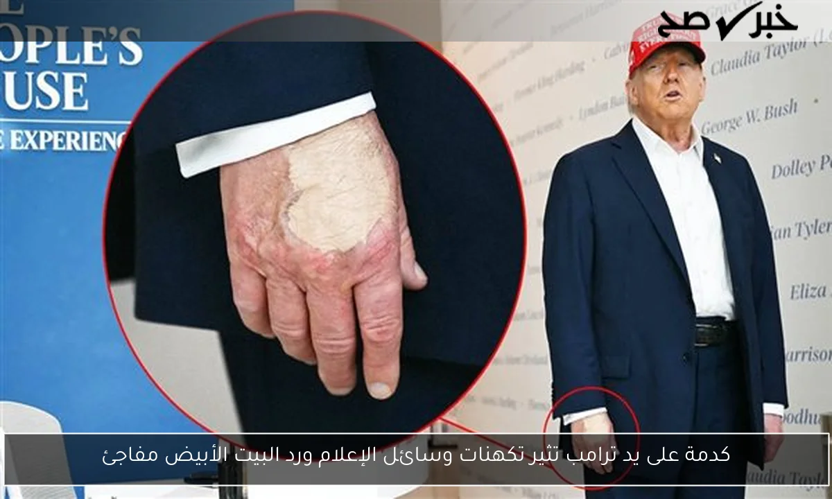 كدمة على يد ترامب تثير تكهنات وسائل الإعلام ورد البيت الأبيض مفاجئ