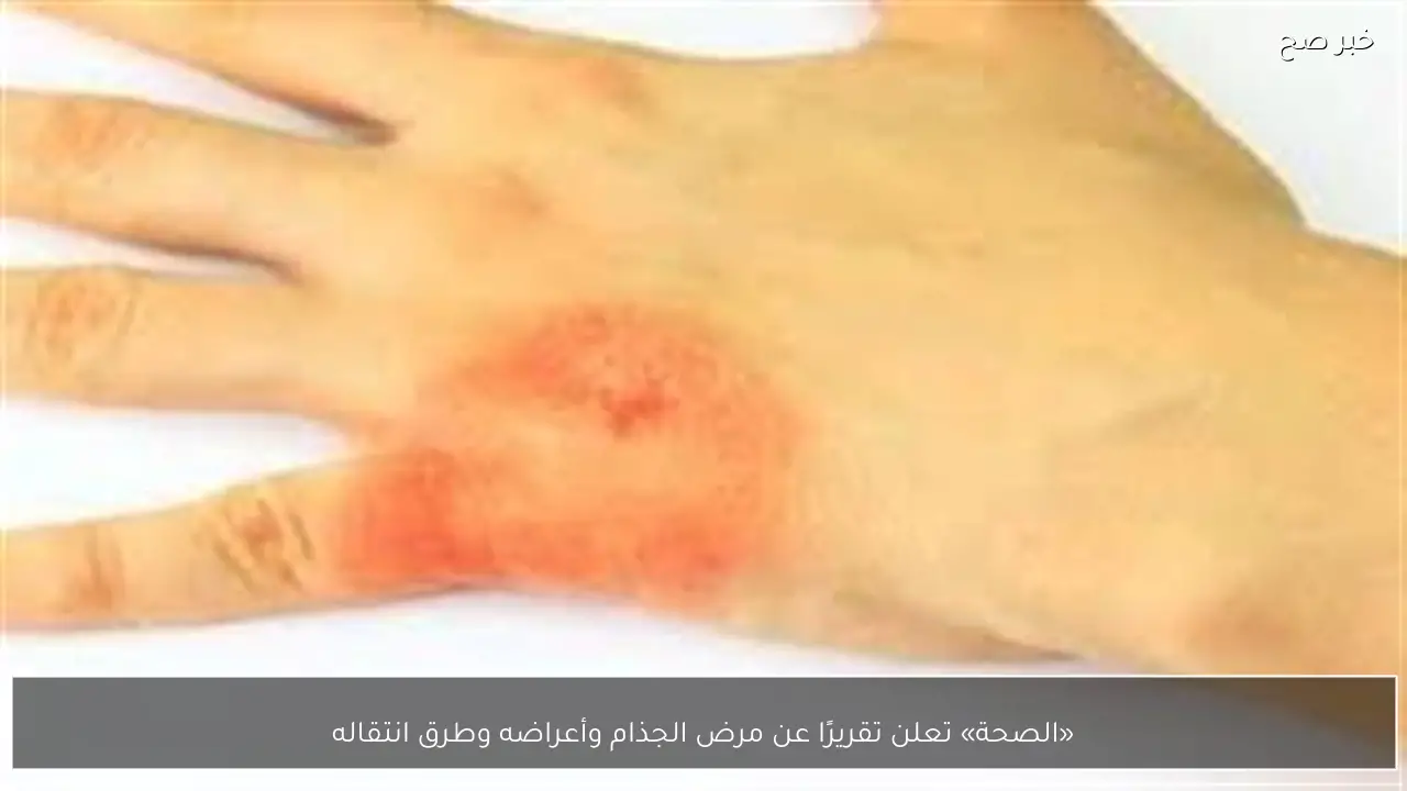 «الصحة» تعلن تقريرًا عن مرض الجذام وأعراضه وطرق انتقاله