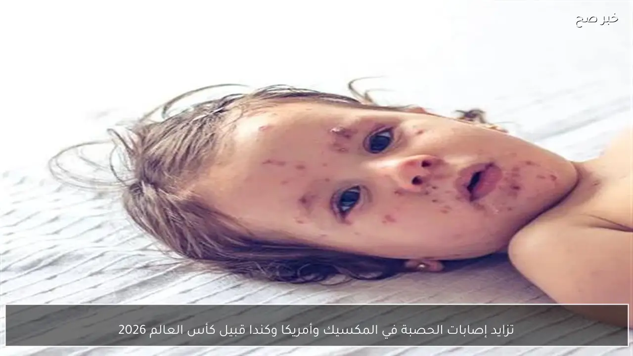 تزايد إصابات الحصبة في المكسيك وأمريكا وكندا قبيل كأس العالم 2026