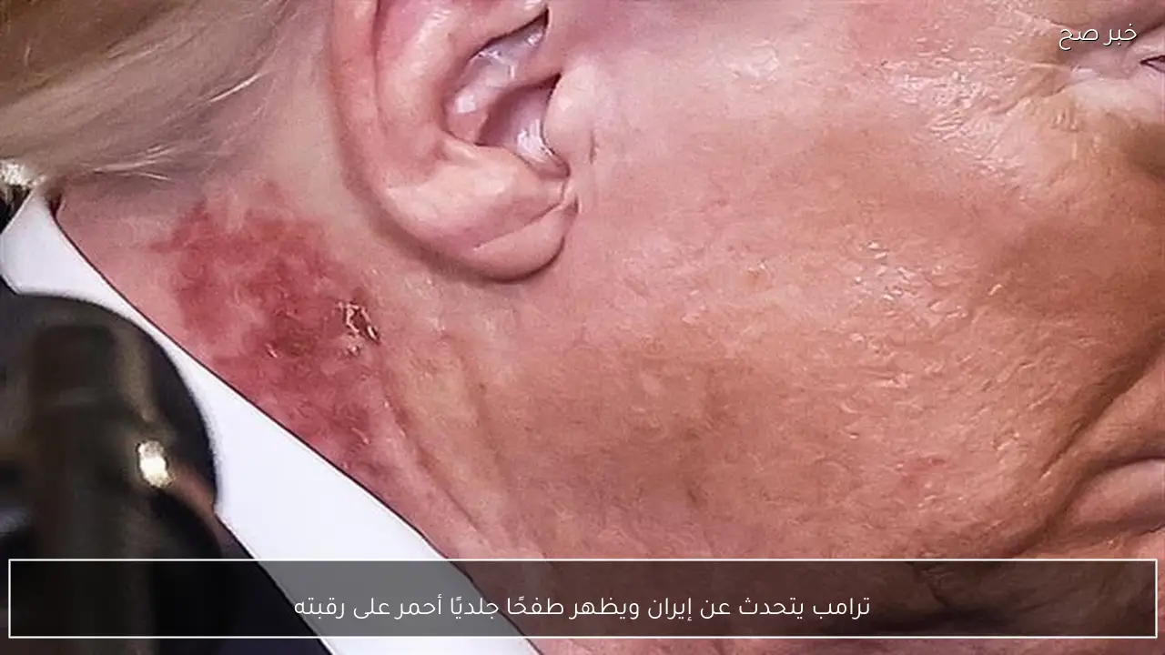 ترامب يتحدث عن إيران ويظهر طفحًا جلديًا أحمر على رقبته